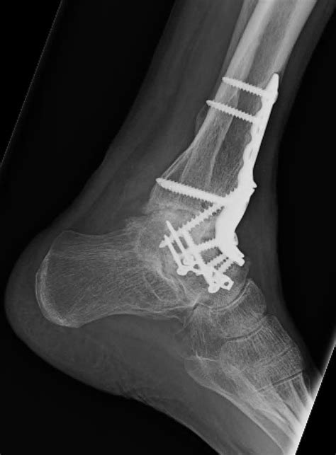 Ankle Arthritis Foot And Ankle Orthobullets