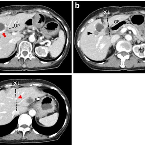 Abdominal Contrast Enhanced Ct Before Colectomy Demonstrates 2 Tumors