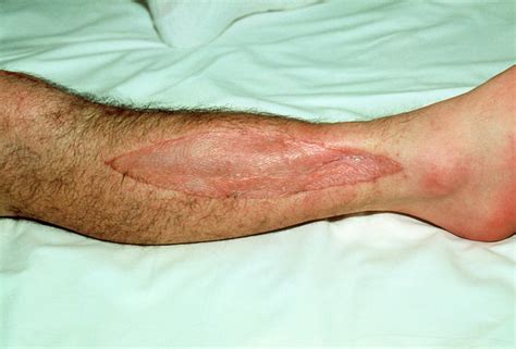 Healing Skin Graft On Patient S Leg Photograph By Mike Devlin Science Photo Library Pixels Merch