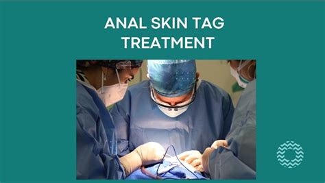 Anal Skin Tag Removal Treatment Options Ny Breaking News