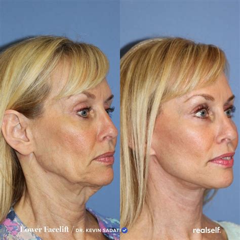 Lower Facelift What To Expect Results Cost Realself Sagging Skin