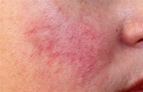 Help My Skin Is Always Red — What Could It Be Manhattan Dermatology