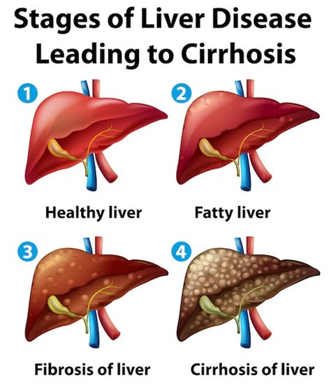 What Are The Different Stages Of Liver Failure Images