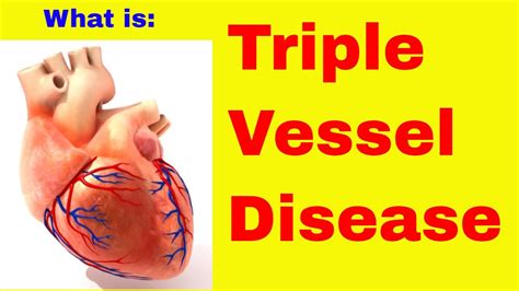 What Is Triple Vessel Disease Youtube
