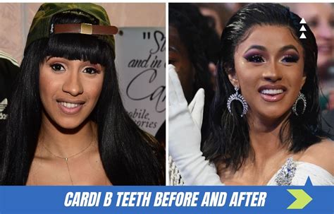 Cardi B Teeth Before And After The Change In Cardi B S Teeth Did Not