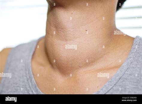 Goiter Woman Hi Res Stock Photography And Images Alamy
