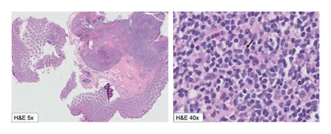 The Hande Sections Show Proliferation Of Atypical Lymphoid Cells