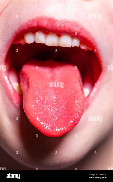 Tongue Of A Child With Scarlet Fever Strawberry Tongue Stock Photo
