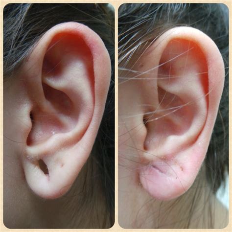What Is Earlobe Repair Surgery In Cheshire