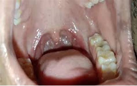 Intratonsillar Abscess Case Series Of A Rare Entity