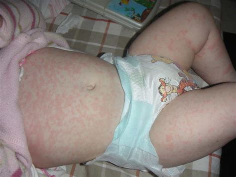 Baby Rashes On Stomach Pictures Photos