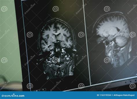 Dementia On Mri Film Brain Dementia Stock Photo Image Of Neurology