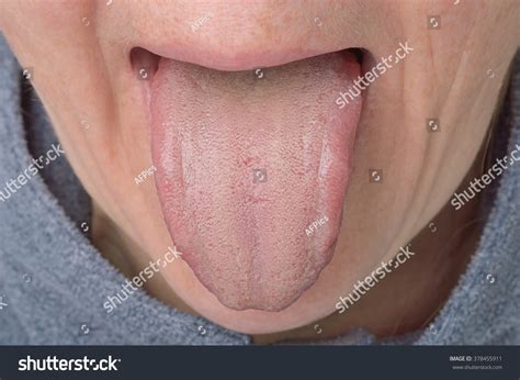 Coated Protruded Tongue Stock Photo 378455911 Shutterstock