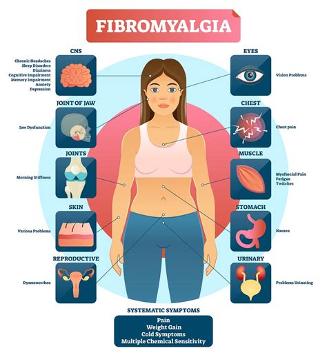 Facts About Fibromyalgia