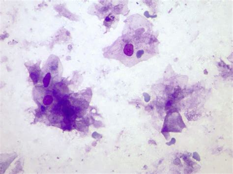 Fna Cytology Smear Showed Sheets Of Abundant Benign Squamous Cells In