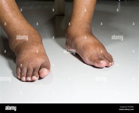 The Feet Of People With Diabetes Dull And Swollen Due To The Toxicity