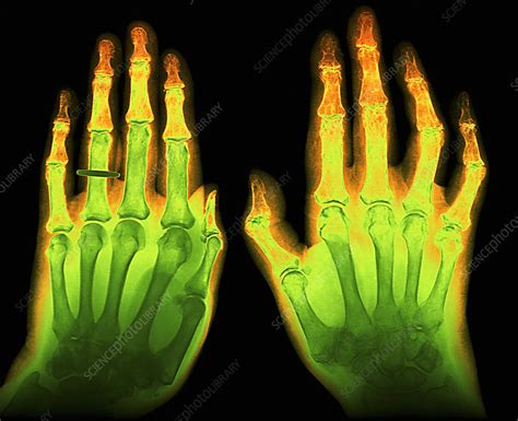 Arthritic Hand X Ray Stock Image M1100597 Science Photo Library
