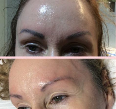 Before And After Photos Hrh Laser Hair Treatments