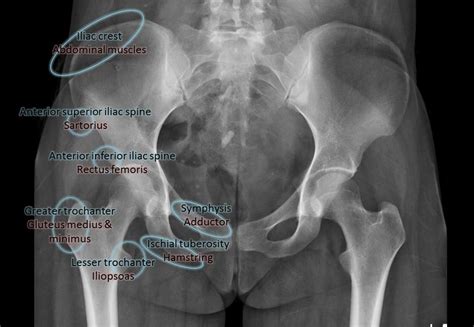 Pelvic Floor Muscles Radiology