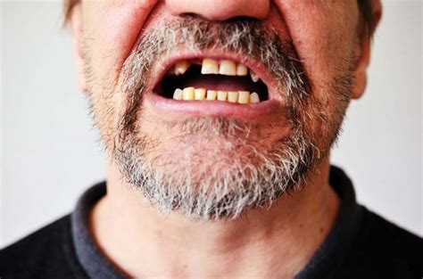 Uitgeslagen Tand Lees Wat U Moet Doen Dental365