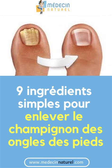9 Ingrédients Simples Pour Enlever Le Champignon Des Ongles Des Pieds