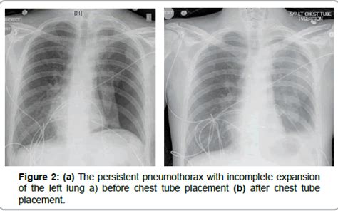 Pneumothorax Surgery