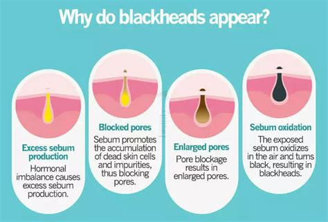 How To Get Rid Of Blackheads The Yesstylist