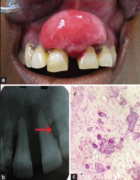 A Intraoral Photograph Of Case 1 B Intraoral Periapical Of The