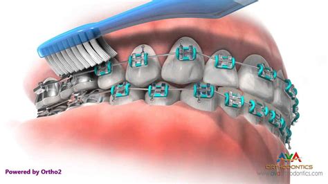 Brushing the same way as you. Life with Braces - Brushing & Flossing - YouTube