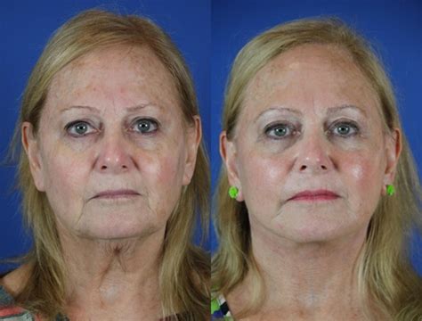 Facelift Reflection Lift Before After Photo Gallery Brentwood Tn