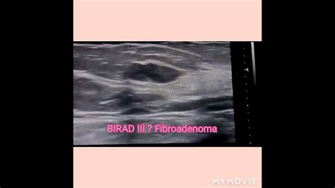 Fibroadenoma Ultrasound Youtube