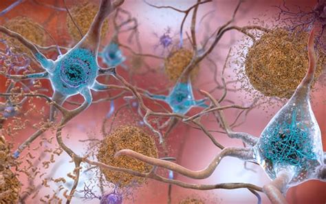 Novel Drug Prevents Amyloid Plaques A Hallmark Of Alzheimers Disease