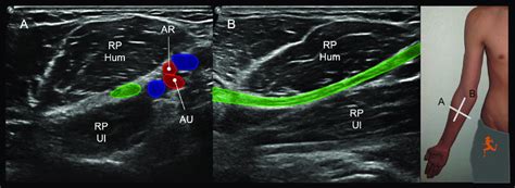 Us Depicting The Median Nerve At The Level Of The Pronator Teres