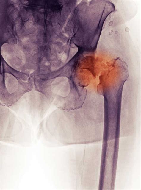 How Do You Know If You Have A Hip Fracture Hip Fracture Fractures Joint