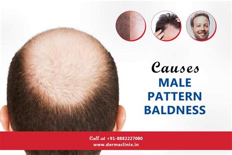 What Are The Causes Of Male Pattern Baldness Dermaclinix