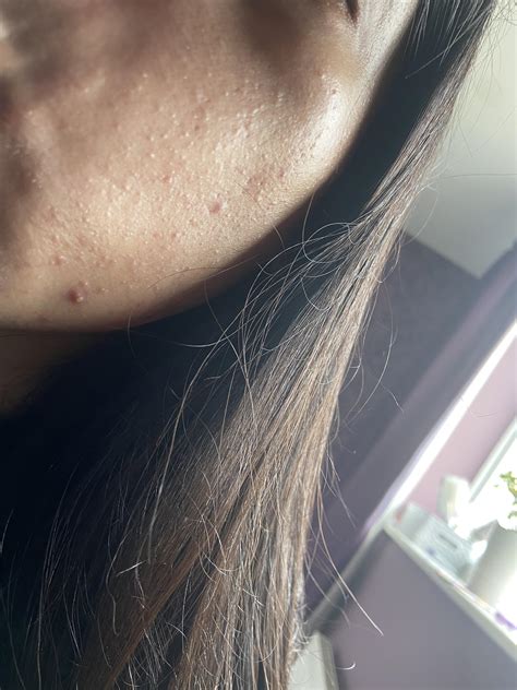 Skin Concern Is Differin Daily Use Causing Tiny Spots To Appear All
