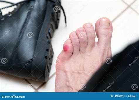 Bloody Terrible Blister On Human Feet With New Black Leather Shoes