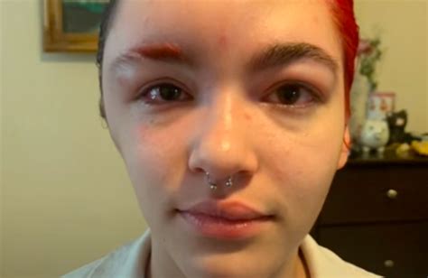 19 Year Old Goes Viral After Allergic Reaction To Hair Dye