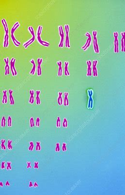 Karyotype Of Turner S Syndrome Stock Image M Science