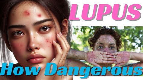 How Dangerous Is Lupus Understanding Autoimmune Symptoms Causes