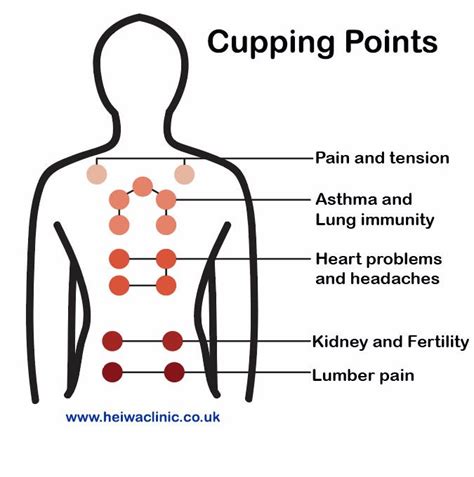 cupping therapy for better health