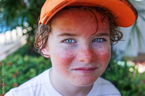 Red Painful Skin Sunburn On The Boys Face Sunburn Protection Need