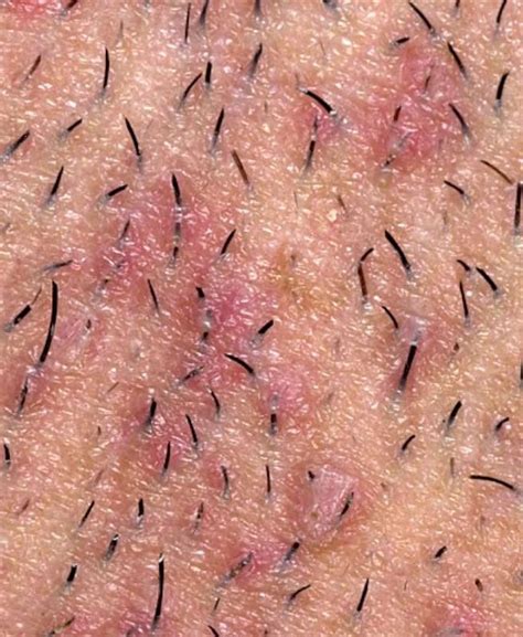 How do i shave pubic hair without getting red bumps? Get Rid Of Ingrown Hair | Trusper