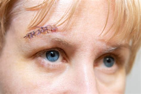 Head Stitches Stock Photos Pictures And Royalty Free Images Istock