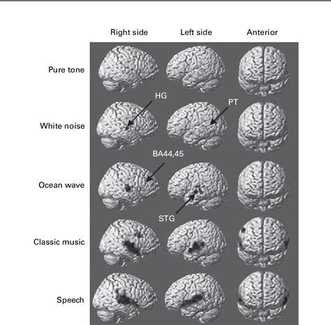 Figure 1 From Hemispheric Difference In Activation Patterns Of Human