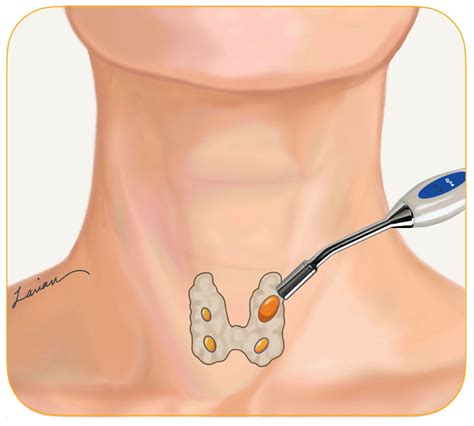 Radioguided Parathyroid Surgery Hyperparathyroidism Surgery Dr