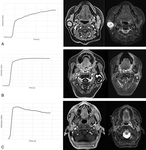 Dynamic Contrast Enhanced Mri To Differentiate Parotid Neoplasms Using