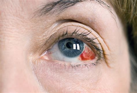 How To Get Rid Of Red Eyes Causes And Treatments