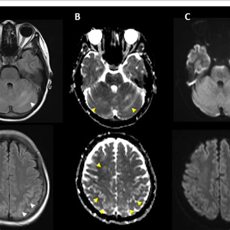 Brain Magnetic Resonance Imaging Mri 5 Days After Onset Of First