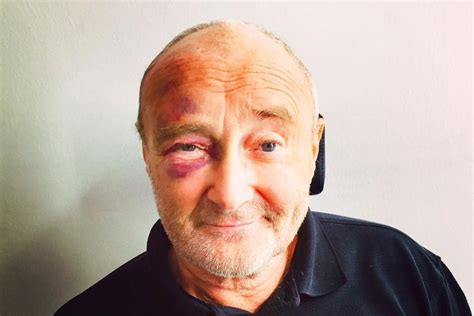 Phil collins.as a solo artist he has sold more than 1. Phil Collins suffers black eye as bathroom fall nearly ...